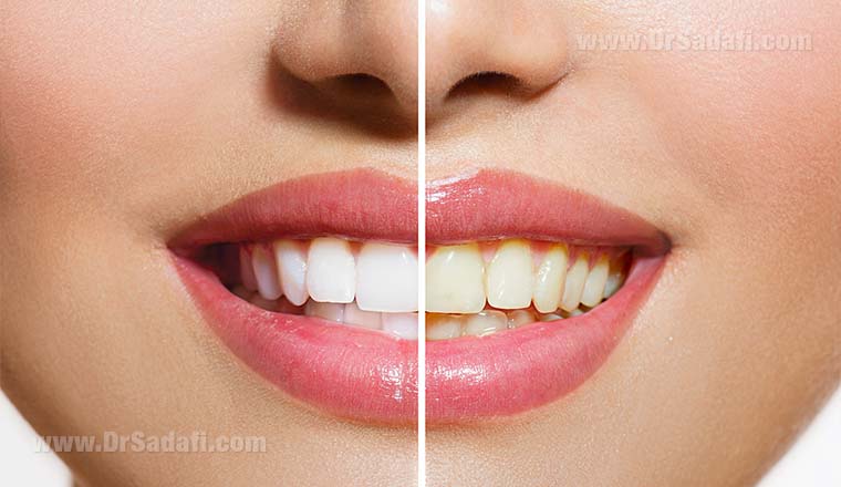 بلیچینگ (سفید کردن دندان) در خانه بهتر است یا در مطب؟