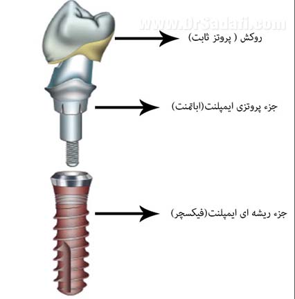 اجزای ایمپلنت