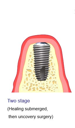 ایمپلنت دو مرحله ای
