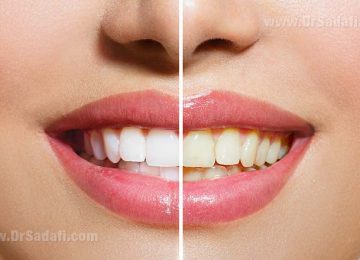 بلیچینگ (سفید کردن دندان) در خانه بهتر است یا در مطب؟