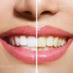 Teeth Whitening (Bleaching): In-office vs. at Home