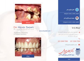 ایمپلنت دندان - پروتز دندان