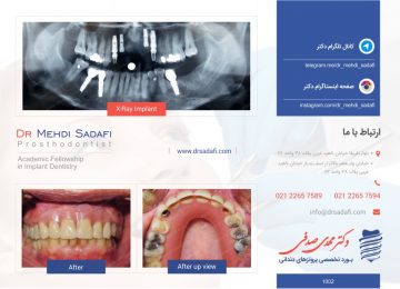 ایمپلنت دندان - پروتز دندان
