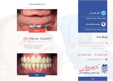 ایمپلنت دندان - پروتز دندان