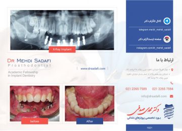 ایمپلنت دندان - پروتز دندان