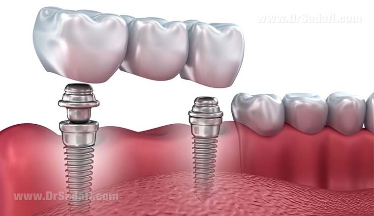 Dental Implants