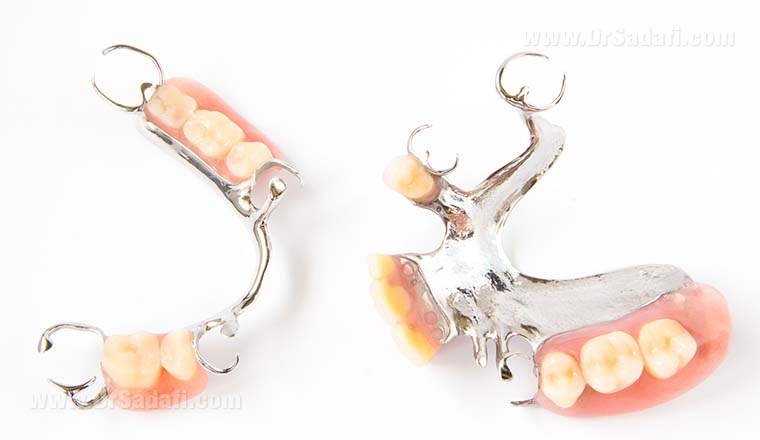 Dental prosthesis